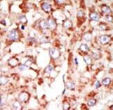 Formalin-fixed and paraffin-embedded human cancer tissue reacted with the primary antibody, which was peroxidase-conjugated to the secondary antibody, followed by DAB staining. This data demonstrates the use of this antibody for immunohistochemistry; clinical relevance has not been evaluated. BC = breast carcinoma; HC = hepatocarcinoma.