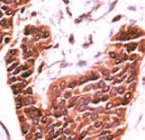 Formalin-fixed and paraffin-embedded human cancer tissue reacted with the primary antibody, which was peroxidase-conjugated to the secondary antibody, followed by DAB staining. This data demonstrates the use of this antibody for immunohistochemistry; clinical relevance has not been evaluated. BC = breast carcinoma; HC = hepatocarcinoma.