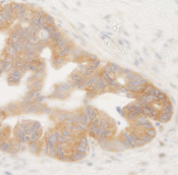Detection of Human BIRC6/Apollon by Immunohistochemistry. Sample: FFPE section of human ovarian tumor. Antibody: Affinity purified rabbit anti-BIRC6/Apollon used at a dilution of 1:250.