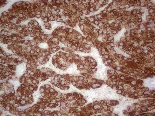 IHC of paraffin-embedded Carcinoma of Human liver tissue using anti-ABAT mouse monoclonal antibody. (Heat-induced epitope retrieval by 1 mM EDTA in 10mM Tris, pH8.5, 120°C for 3min).