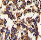 BSCL2 Antibody immunohistochemistry of formalin-fixed and paraffin-embedded human testis carcinoma followed by peroxidase-conjugated secondary antibody and DAB staining.