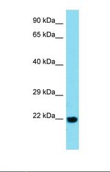 Western blot of Human Esophagus Tumor. BTBD2 antibody dilution 1.0 ug/ml.