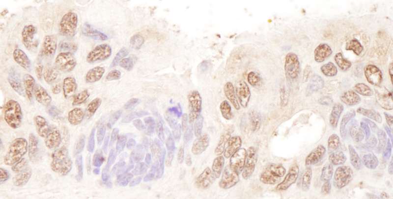 Detection of Human BTF by Immunohistochemistry. Sample: FFPE section of human ovarian carcinoma. Antibody: Affinity purified rabbit anti-BTF used at a dilution of 1:200 (1 ug/ml).