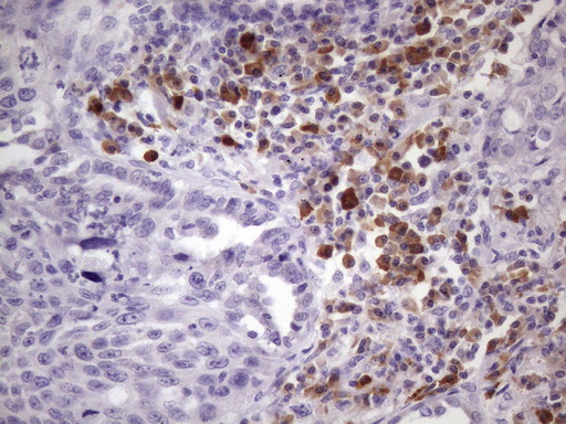 IHC of paraffin-embedded Carcinoma of Human lung tissue using anti-BTG2 mouse monoclonal antibody. (Heat-induced epitope retrieval by 1 mM EDTA in 10mM Tris, pH8.5, 120°C for 3min)(1:150).