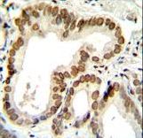 BTG2 Antibody immunohistochemistry of formalin-fixed and paraffin-embedded human prostate carcinoma followed by peroxidase-conjugated secondary antibody and DAB staining.