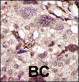 Formalin-fixed and paraffin-embedded human cancer tissue reacted with the primary antibody, which was peroxidase-conjugated to the secondary antibody, followed by DAB staining. This data demonstrates the use of this antibody for immunohistochemistry; clinical relevance has not been evaluated. BC = breast carcinoma; HC = hepatocarcinoma.