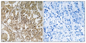 IHC of paraffin-embedded human breast carcinoma tissue, using BUB1 Antibody. The picture on the right is treated with the synthesized peptide.