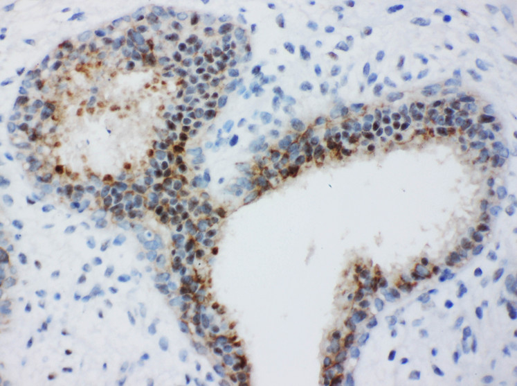 BUB3 antibody. IHC(P): Human Breast Cancer Tissue.