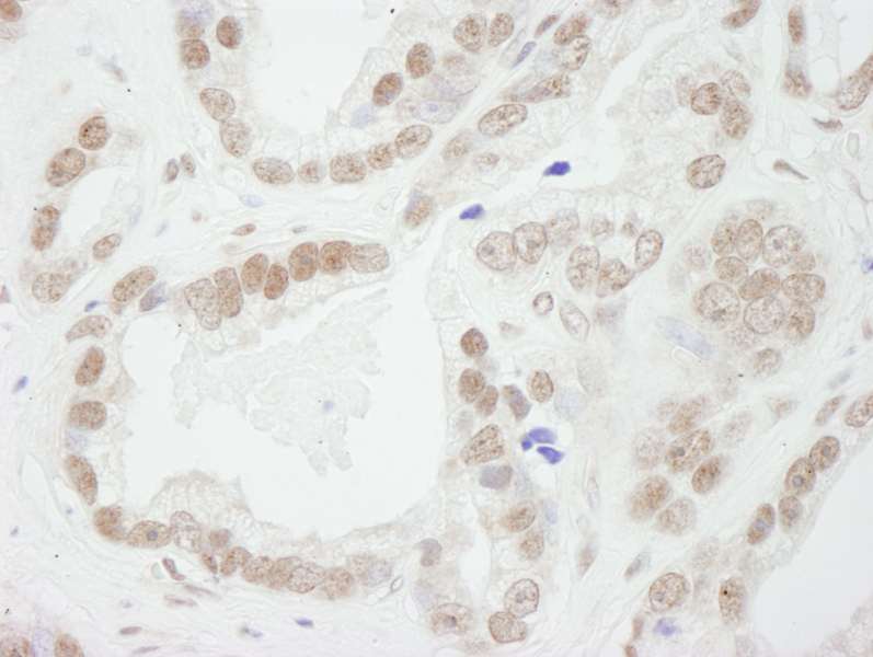 Detection of Human BUB3 by Immunohistochemistry. Sample: FFPE section of human prostate adenocarcinoma. Antibody: Affinity purified rabbit anti-BUB3 used at a dilution of 1:250.