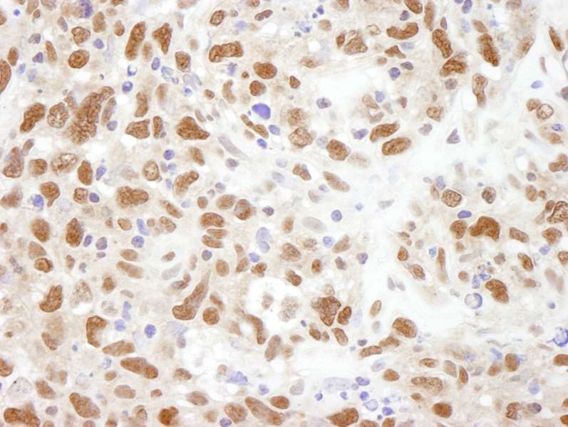 Detection of Human BUB3 by Immunohistochemistry. Sample: FFPE section of human metastatic lymph node. Antibody: Affinity purified rabbit anti-BUB3 used at a dilution of 1:250.