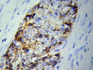 Immunohistochemistry (IHC) analysis of BVES pAb in paraffin-embedded Ovary tumor tissue.