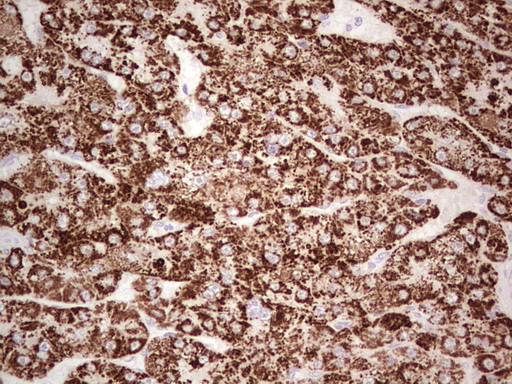 IHC of paraffin-embedded Carcinoma of Human liver tissue using anti-ABAT mouse monoclonal antibody. (Heat-induced epitope retrieval by 1 mM EDTA in 10mM Tris, pH8.5, 120°C for 3min).
