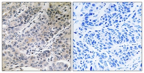 IHC of paraffin-embedded human lung carcinoma tissue, using BRP44 Antibody. The picture on the right is treated with the synthesized peptide.