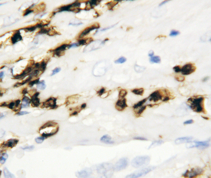 C/EBP Alpha / CEBPA antibody. IHC(P): Human Breast Cancer Tissue.