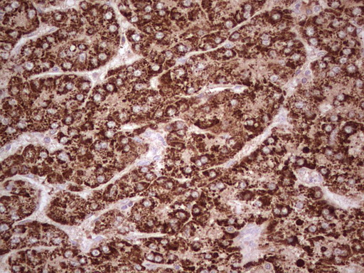 IHC of paraffin-embedded Carcinoma of Human liver tissue using anti-ABAT mouse monoclonal antibody. (Heat-induced epitope retrieval by 1 mM EDTA in 10mM Tris, pH8.5, 120°C for 3min).