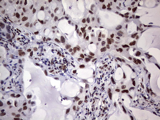 IHC of paraffin-embedded Carcinoma of Human lung tissue using anti-C14orf166 mouse monoclonal antibody. (Heat-induced epitope retrieval by 1 mM EDTA in 10mM Tris, pH8.5, 120°C for 3min).