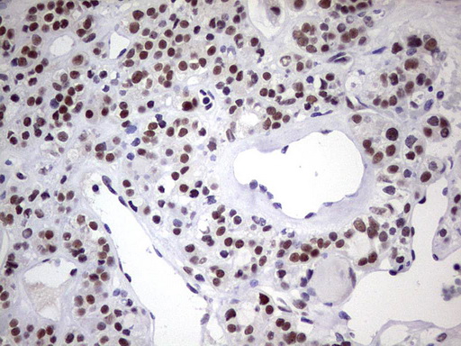 IHC of paraffin-embedded Carcinoma of Human thyroid tissue using anti-C14orf166 mouse monoclonal antibody. (Heat-induced epitope retrieval by 1 mM EDTA in 10mM Tris, pH8.5, 120°C for 3min).