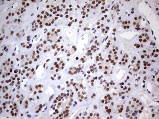 IHC of paraffin-embedded Carcinoma of Human thyroid tissue using anti-C14orf166 mouse monoclonal antibody. (Heat-induced epitope retrieval by 1 mM EDTA in 10mM Tris, pH8.5, 120°C for 3min).