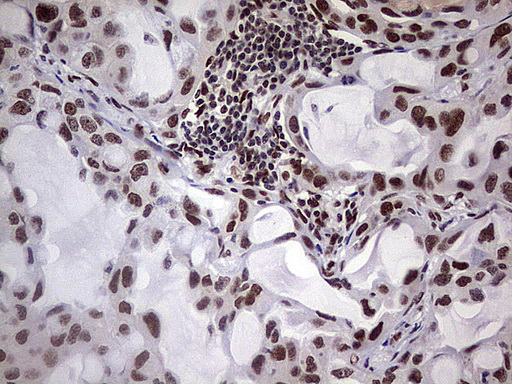 IHC of paraffin-embedded Carcinoma of Human lung tissue using anti-C14orf166 mouse monoclonal antibody. (Heat-induced epitope retrieval by 1 mM EDTA in 10mM Tris, pH8.5, 120°C for 3min).