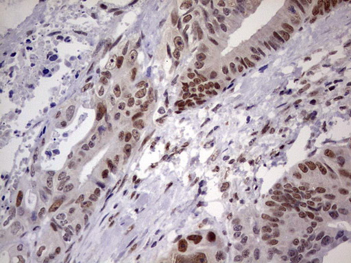 IHC of paraffin-embedded Adenocarcinoma of Human colon tissue using anti-C14orf166 mouse monoclonal antibody. (Heat-induced epitope retrieval by 1 mM EDTA in 10mM Tris, pH8.5, 120°C for 3min).