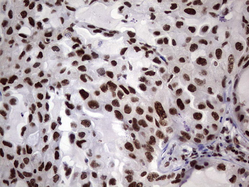 IHC of paraffin-embedded Carcinoma of Human lung tissue using anti-C14orf166 mouse monoclonal antibody. (Heat-induced epitope retrieval by 1 mM EDTA in 10mM Tris, pH8.5, 120°C for 3min).
