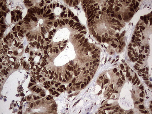 IHC of paraffin-embedded Adenocarcinoma of Human colon tissue using anti-C14orf166 mouse monoclonal antibody. (Heat-induced epitope retrieval by 1 mM EDTA in 10mM Tris, pH8.5, 120°C for 3min).