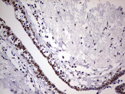 IHC of paraffin-embedded Adenocarcinoma of Human breast tissue using anti-C14orf166 mouse monoclonal antibody. (Heat-induced epitope retrieval by 1 mM EDTA in 10mM Tris, pH8.5, 120°C for 3min).