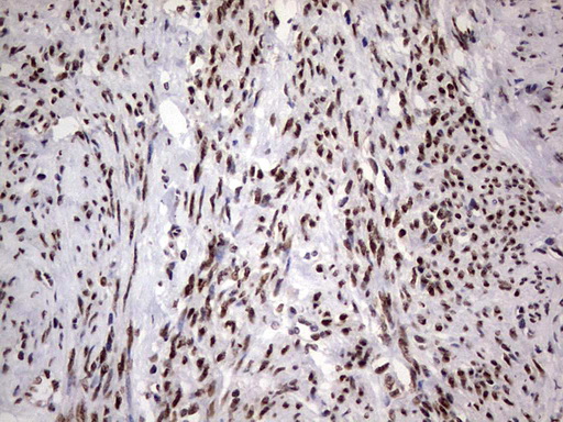 IHC of paraffin-embedded Adenocarcinoma of Human endometrium tissue using anti-C14orf166 mouse monoclonal antibody. (Heat-induced epitope retrieval by 1 mM EDTA in 10mM Tris, pH8.5, 120°C for 3min).