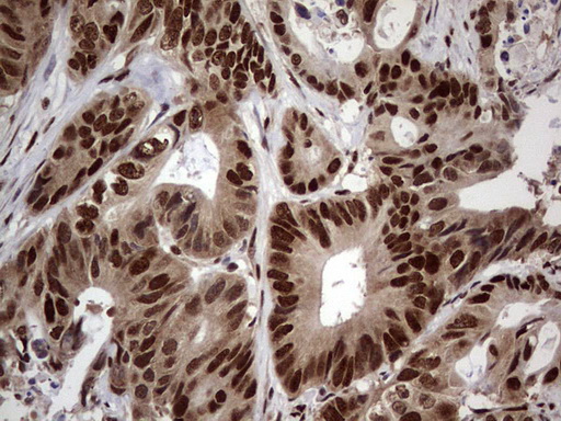 IHC of paraffin-embedded Adenocarcinoma of Human colon tissue using anti-C14orf166 mouse monoclonal antibody. (Heat-induced epitope retrieval by 1 mM EDTA in 10mM Tris, pH8.5, 120°C for 3min).