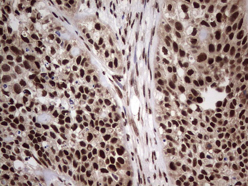 IHC of paraffin-embedded Carcinoma of Human kidney tissue using anti-C14orf166 mouse monoclonal antibody. (Heat-induced epitope retrieval by 1 mM EDTA in 10mM Tris, pH8.5, 120°C for 3min).