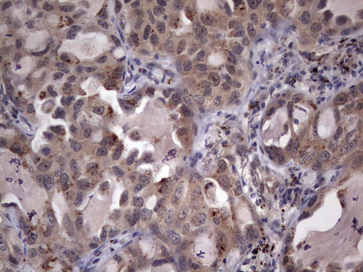 IHC of paraffin-embedded Carcinoma of Human lung tissue using anti-C14orf166 mouse monoclonal antibody. (Heat-induced epitope retrieval by 1 mM EDTA in 10mM Tris, pH8.5, 120°C for 3min).