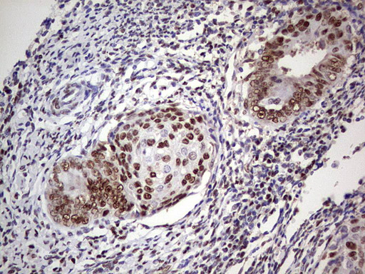 IHC of paraffin-embedded Adenocarcinoma of Human endometrium tissue using anti-C14orf166 mouse monoclonal antibody. (Heat-induced epitope retrieval by 1 mM EDTA in 10mM Tris, pH8.5, 120°C for 3min).