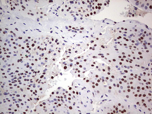IHC of paraffin-embedded Carcinoma of Human thyroid tissue using anti-C14orf166 mouse monoclonal antibody. (Heat-induced epitope retrieval by 1 mM EDTA in 10mM Tris, pH8.5, 120°C for 3min).