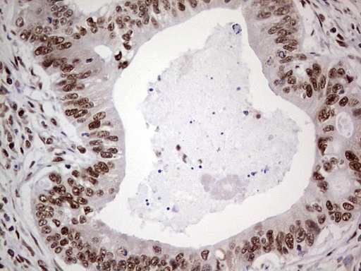 IHC of paraffin-embedded Adenocarcinoma of Human colon tissue using anti-C14orf166 mouse monoclonal antibody. (Heat-induced epitope retrieval by 1 mM EDTA in 10mM Tris, pH8.5, 120°C for 3min).