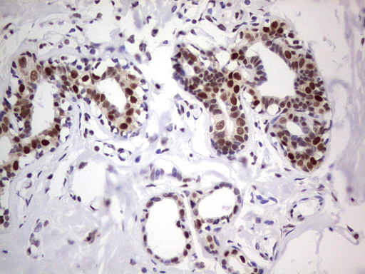 IHC of paraffin-embedded Adenocarcinoma of Human breast tissue using anti-C14orf166 mouse monoclonal antibody. (Heat-induced epitope retrieval by 1 mM EDTA in 10mM Tris, pH8.5, 120°C for 3min).
