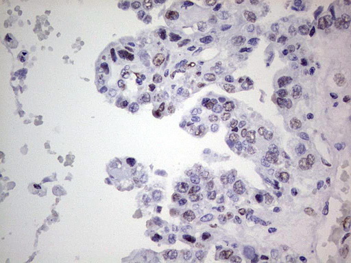 IHC of paraffin-embedded Adenocarcinoma of Human ovary tissue using anti-C14orf166 mouse monoclonal antibody. (Heat-induced epitope retrieval by 1 mM EDTA in 10mM Tris, pH8.5, 120°C for 3min).