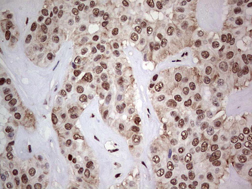 IHC of paraffin-embedded Carcinoma of Human liver tissue using anti-C14orf166 mouse monoclonal antibody. (Heat-induced epitope retrieval by 1 mM EDTA in 10mM Tris, pH8.5, 120°C for 3min).