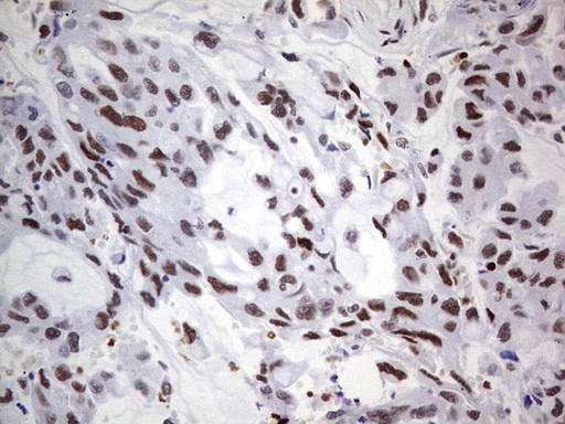 IHC of paraffin-embedded Carcinoma of Human lung tissue using anti-C14orf166 mouse monoclonal antibody. (Heat-induced epitope retrieval by 1 mM EDTA in 10mM Tris, pH8.5, 120°C for 3min).