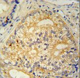 CP013 antibody immunohistochemistry of formalin-fixed and paraffin-embedded human prostate carcinoma followed by peroxidase-conjugated secondary antibody and DAB staining.