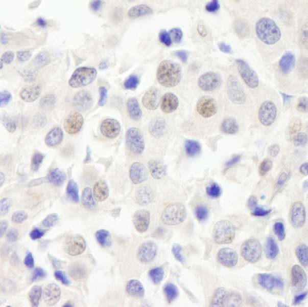Detection of Human ABC2 by Immunohistochemistry. Sample: FFPE section of human breast carcinoma. Antibody: Affinity purified rabbit anti-ABC2 used at a dilution of 1:1000 (1 ug/ml).