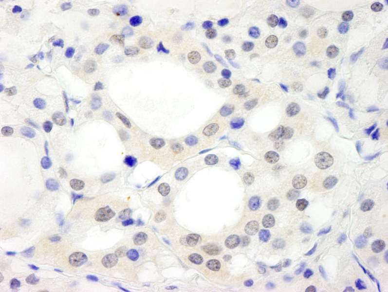 Detection of Human ABC2 by Immunohistochemistry. Sample: FFPE section of human thyroid carcinoma. Antibody: Affinity purified rabbit anti-ABC2 used at a dilution of 1:250.