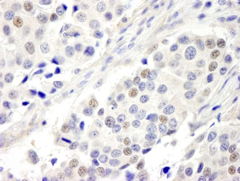 Detection of Human ABC2 by Immunohistochemistry. Sample: FFPE section of human breast carcinoma. Antibody: Affinity purified rabbit anti-ABC2 used at a dilution of 1:250.