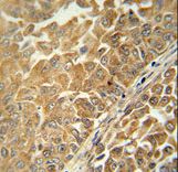 CR025 antibody immunohistochemistry of formalin-fixed and paraffin-embedded human bladder carcinoma followed by peroxidase-conjugated secondary antibody and DAB staining.