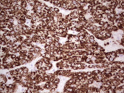 IHC of paraffin-embedded Carcinoma of Human liver tissue using anti-ABAT mouse monoclonal antibody. (Heat-induced epitope retrieval by 1 mM EDTA in 10mM Tris, pH8.5, 120°C for 3min).