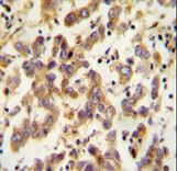 CT173 antibody immunohistochemistry of formalin-fixed and paraffin-embedded human testis carcinoma followed by peroxidase-conjugated secondary antibody and DAB staining.