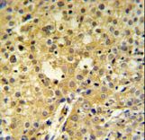C2orf49 Antibody IHC of formalin-fixed and paraffin-embedded human cervix carcinoma followed by peroxidase-conjugated secondary antibody and DAB staining.