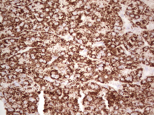 IHC of paraffin-embedded Carcinoma of Human liver tissue using anti-ABAT mouse monoclonal antibody. (Heat-induced epitope retrieval by 1 mM EDTA in 10mM Tris, pH8.5, 120°C for 3min).