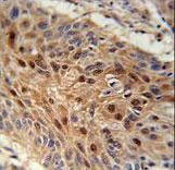 C4orf31 Antibody immunohistochemistry of formalin-fixed and paraffin-embedded human lung carcinoma followed by peroxidase-conjugated secondary antibody and DAB staining.