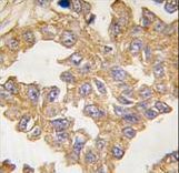 Formalin-fixed and paraffin-embedded human lung carcinoma tissue reacted with ACTB/ACTC antibody , which was peroxidase-conjugated to the secondary antibody, followed by DAB staining. This data demonstrates the use of this antibody for immunohistochemistry; clinical relevance has not been evaluated.