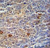 C9orf156 Antibody immunohistochemistry of formalin-fixed and paraffin-embedded human skin carcinoma followed by peroxidase-conjugated secondary antibody and DAB staining.